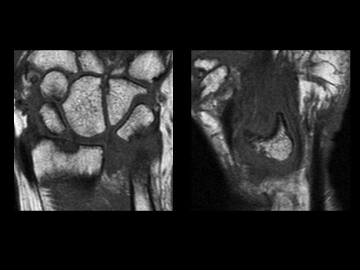 Figure 2 for case Lunate dislocation
